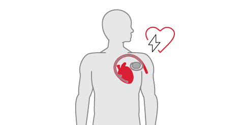 Implantable cardioverter-defibrillator